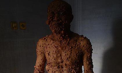 Dựng tóc gáy với người đàn ông 'bong bóng'