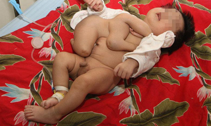Sửng sốt: Bé trai có… 5 chân