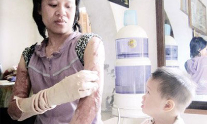 Sau vụ cháy thảm, chồng ly dị vì vợ xấu xí