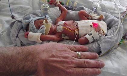 Bé trai sinh ra nhỏ hơn bàn tay sống sót kỳ diệu