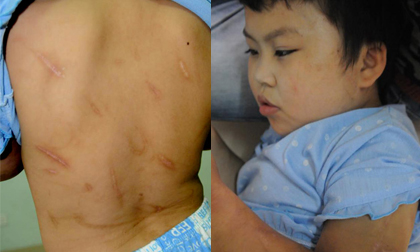 Gia cảnh khốn khổ của bé gái 10 tuổi bị bố đánh dã man