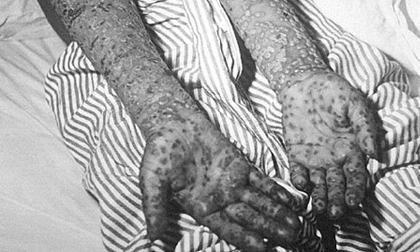 Những vũ khí sinh học đáng sợ nhất trong lịch sử loài người