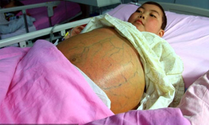 Bé trai có... "bụng bầu" khổng lồ