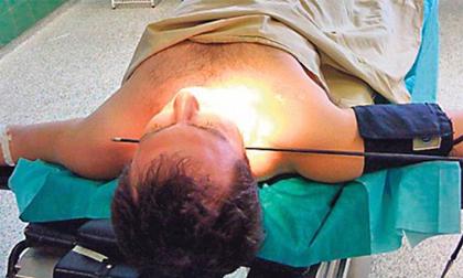 Bị mũi tên xuyên qua cổ vẫn sống sót kỳ diệu