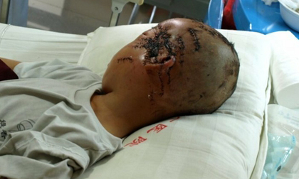 Bé 8 tuổi phải khâu 800 mũi vì bị mẹ chém