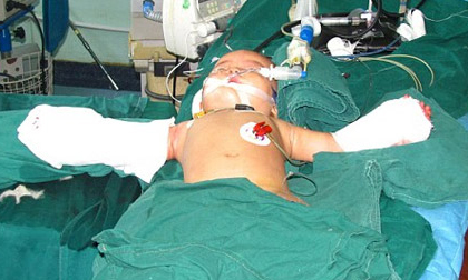 Cháu bé bị bà ngoại cắt cụt hai tay