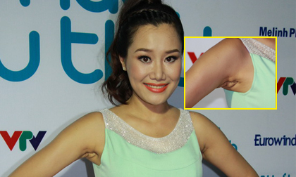MC Nguyệt Ánh lộ vết tích 'dao kéo' vòng ngực