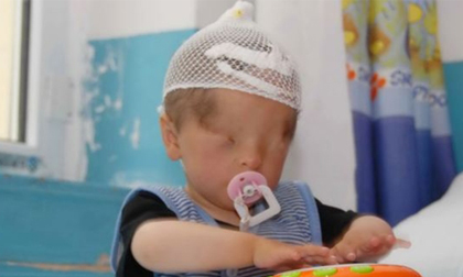 Cậu bé sinh ra không có... mắt