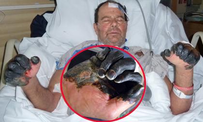 Người đàn ông có bàn tay chết khô do mắc dịch hạch