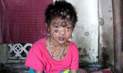 Bé gái 'đeo' hàng trăm khối u