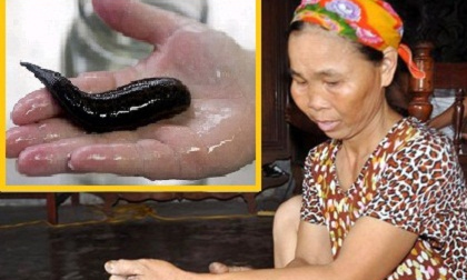 Lý giải chuyện người phụ nữ 'đẻ' ra đỉa