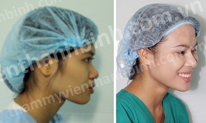 Chất liệu nâng mũi siêu bền mới xuất hiện ở Việt Nam