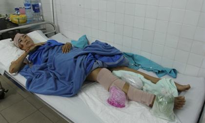 “Nữ hoàng điền kinh” Trương Thanh Hằng bị gãy chân vì tai nạn giao thông 