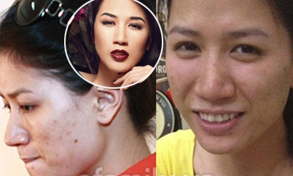 "Lật tẩy" làn da sần không hoàn hảo của sao Việt