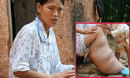 Người phụ nữ chân voi đáng thương ở Trung Quốc