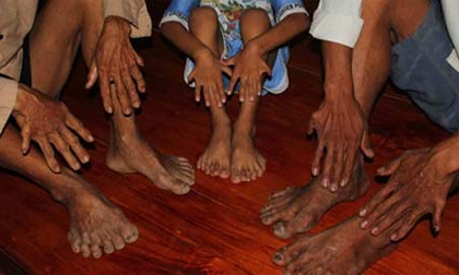 Lạ lùng gia tộc 24 ngón chân, tay ở Việt Nam