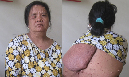 Người phụ nữ hơn 20 năm mang... bộ 'da cóc'