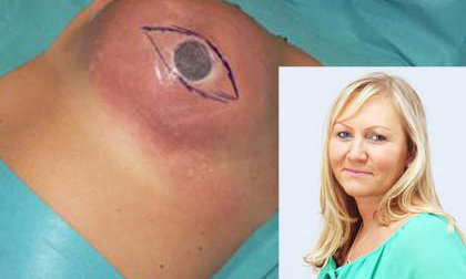 Một phụ nữ bị muỗi đốt "nổ" ngực