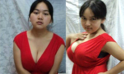 Sốc với bộ ngực "khổng lồ" của bé gái 11 tuổi