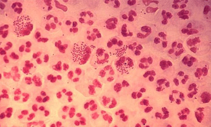 Rùng mình những căn bệnh dễ lây nhiễm qua đường tình dục