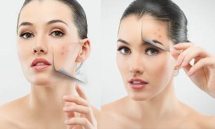 Bí quyết hàng đầu điều trị làn da mụn, da dầu