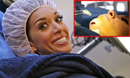 Mỹ nhân loại bỏ mô độn cằm vì hối hận