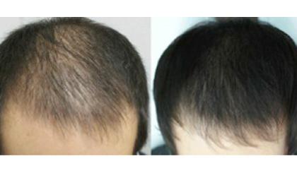 Rụng tóc không còn là nỗi lo!