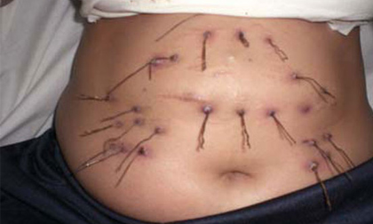 Giật mình người phụ nữ mọc hàng chục chiếc đinh ở bụng