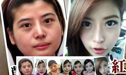 "Choáng" với hình ảnh trước và sau khi gọt mặt của thiếu nữ Đài Loan