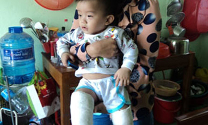 Đón con ở nhà trẻ về thấy gãy cả 2 chân