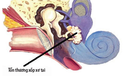 Nguy hiểm từ hội chứng xốp xơ tai