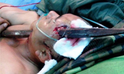 Đang đào đất, bất ngờ bị xà beng đâm xuyên đầu