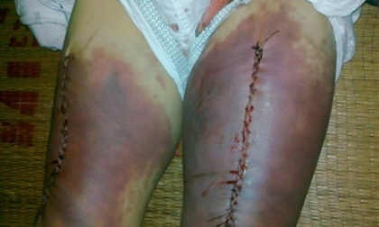 Những vụ điều tra viên đánh đập, ép cung gây rúng động