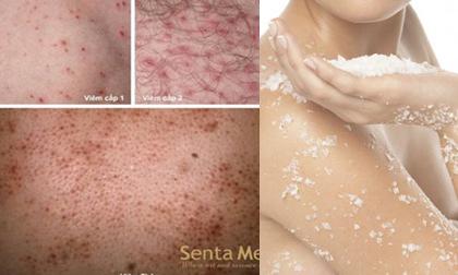 Ưu đãi 25% khi chữa viêm chân lông