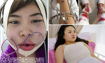 Ám ảnh nỗi đau đớn kinh hoàng trong quá trình phẫu thuật thẩm mỹ