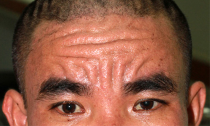 Phát hiện ca bệnh lạ về da đầu tiên trên thế giới