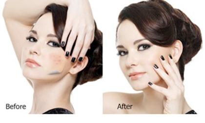 Giải pháp "thổi bay" mụn cho cô dâu trước ngày cưới