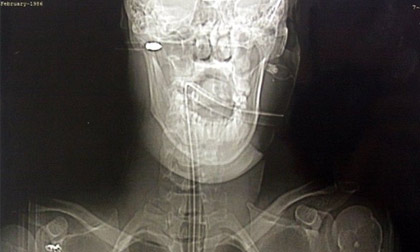 Thoát khỏi tay tử thần khi bị tên bắn xuyên qua đầu