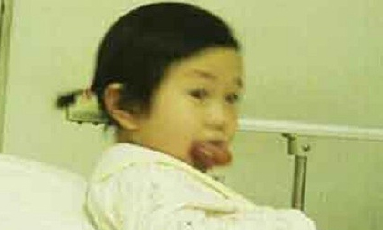 Bé 3 tuổi có lưỡi khổng lồ