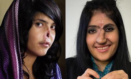 Cô gái bị chồng cắt mũi đã được khôi phục thành công