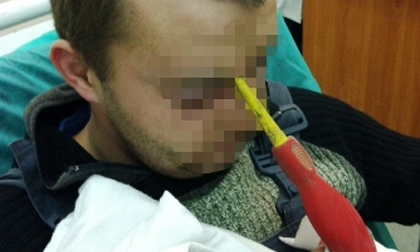 Soi gương mới phát hiện thấy tua-vít đâm xuyên trán