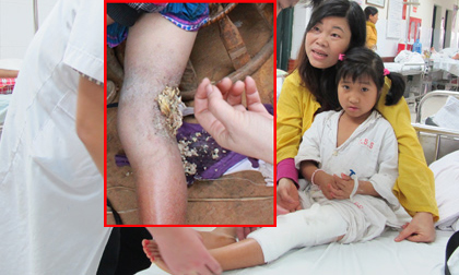 Bé gái 9 tuổi với một bên chân đầy giòi