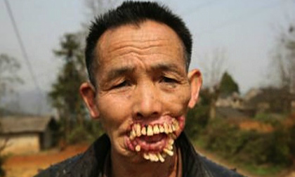 Người đàn ông răng mọc ra ngoài vì sói dại liếm miệng