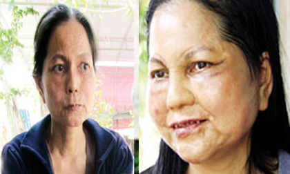 Cô gái 'hóa bà lão' lại bị lão hóa lần thứ 2