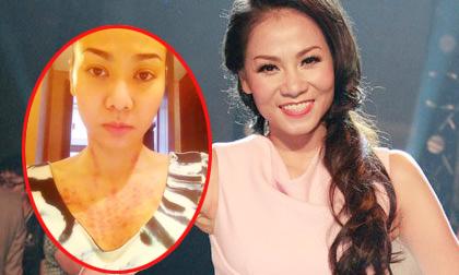 Thu Minh mặt ỉu xìu, ngực mẩn đỏ vì đánh gió