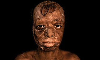 Kinh hãi những khuôn mặt biến dị vì bị tạt axit