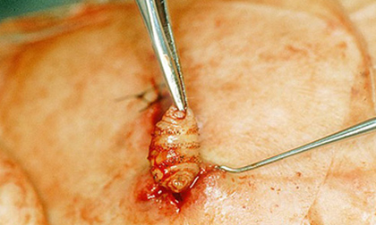 Cận cảnh giòi làm ổ, ăn thịt sống dưới da người