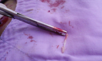 Mê ăn gỏi cá sống, một phụ nữ có sán... ở đùi