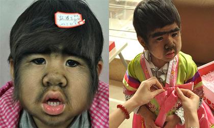 Thêm bé gái Trung Quốc mọc lông khắp cơ thể