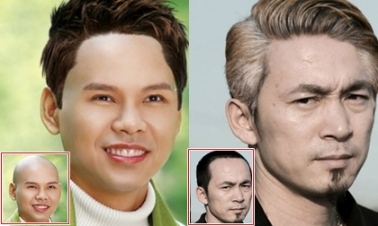 "Cấy tóc" cho sao nam Việt bị... hói đầu